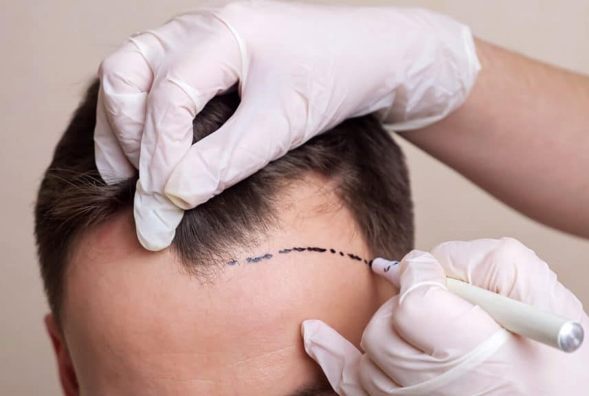 After hair transplant - full hair restoration