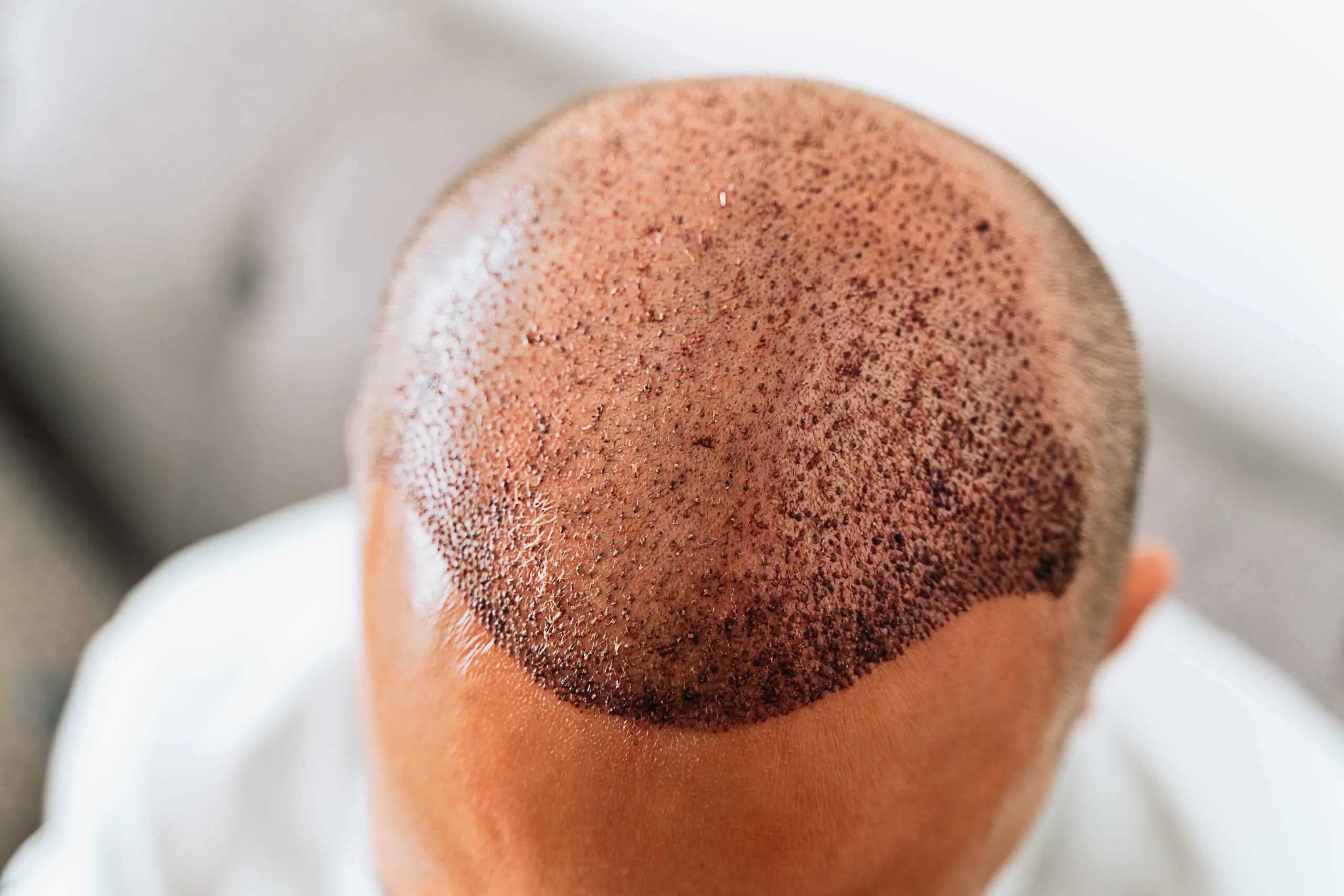 Before hair transplant - receding hairline