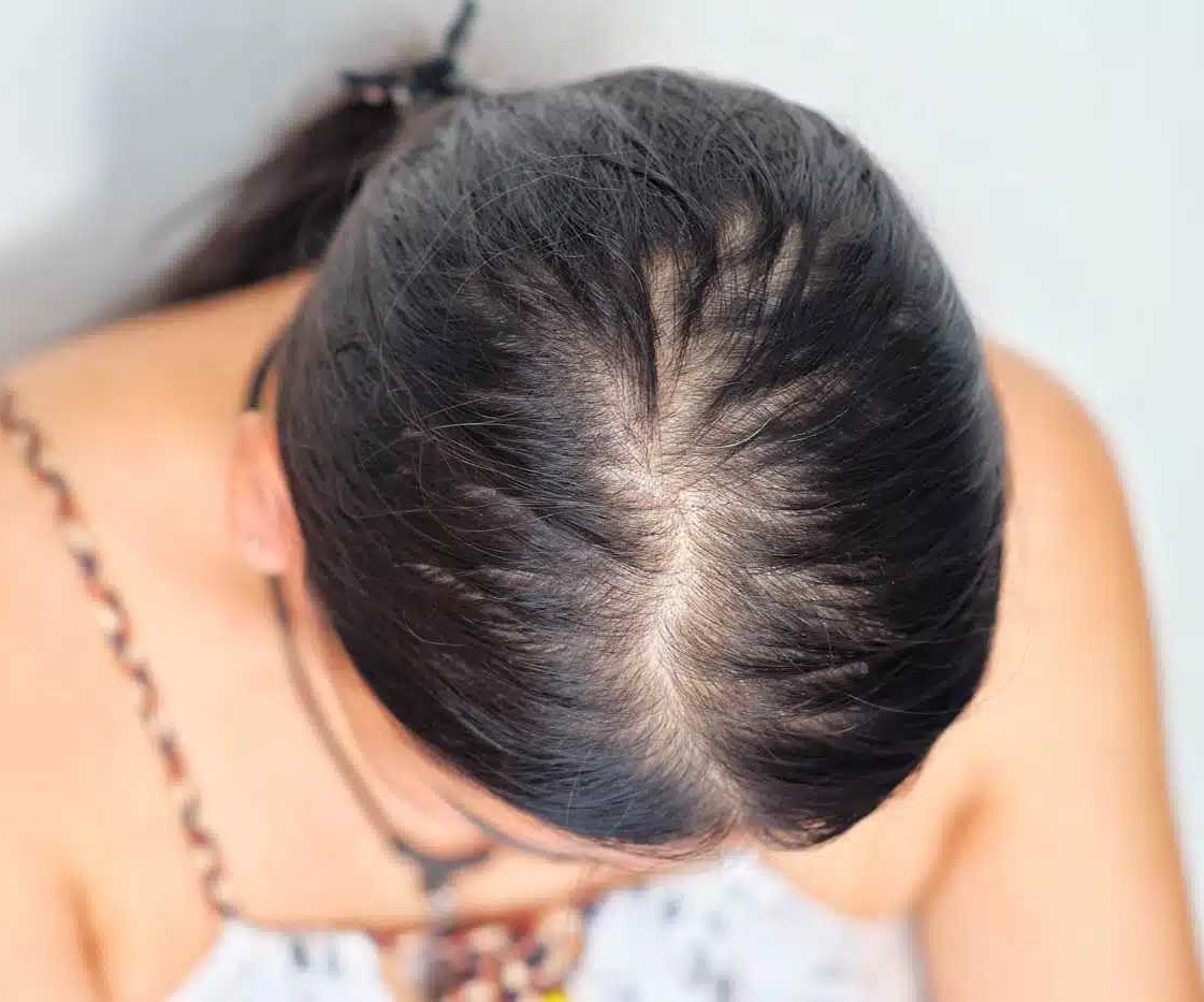 Postpartum Hair Loss