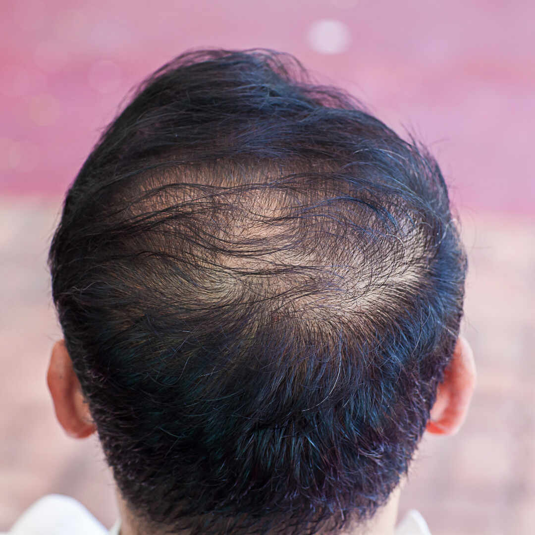 Hair Thinning