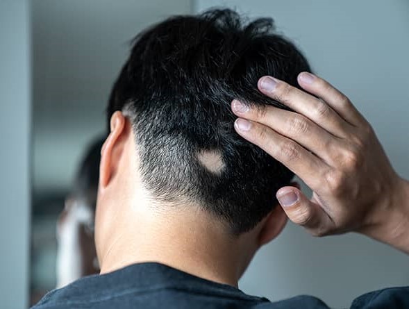 Alopecia Areata