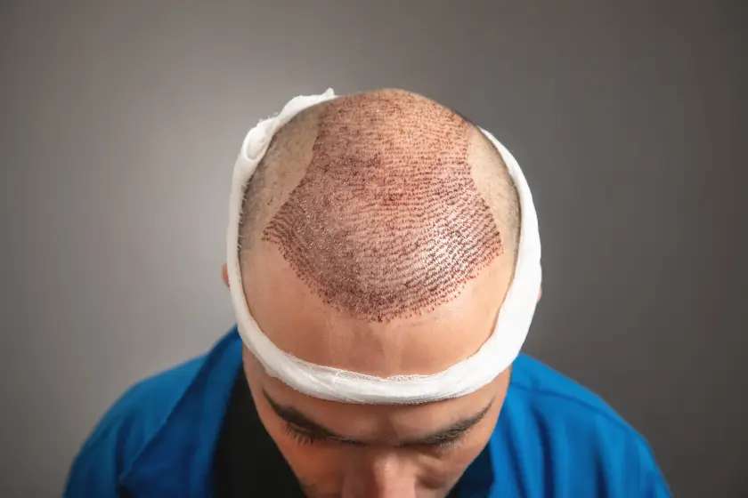 Advanced hair transplant procedure